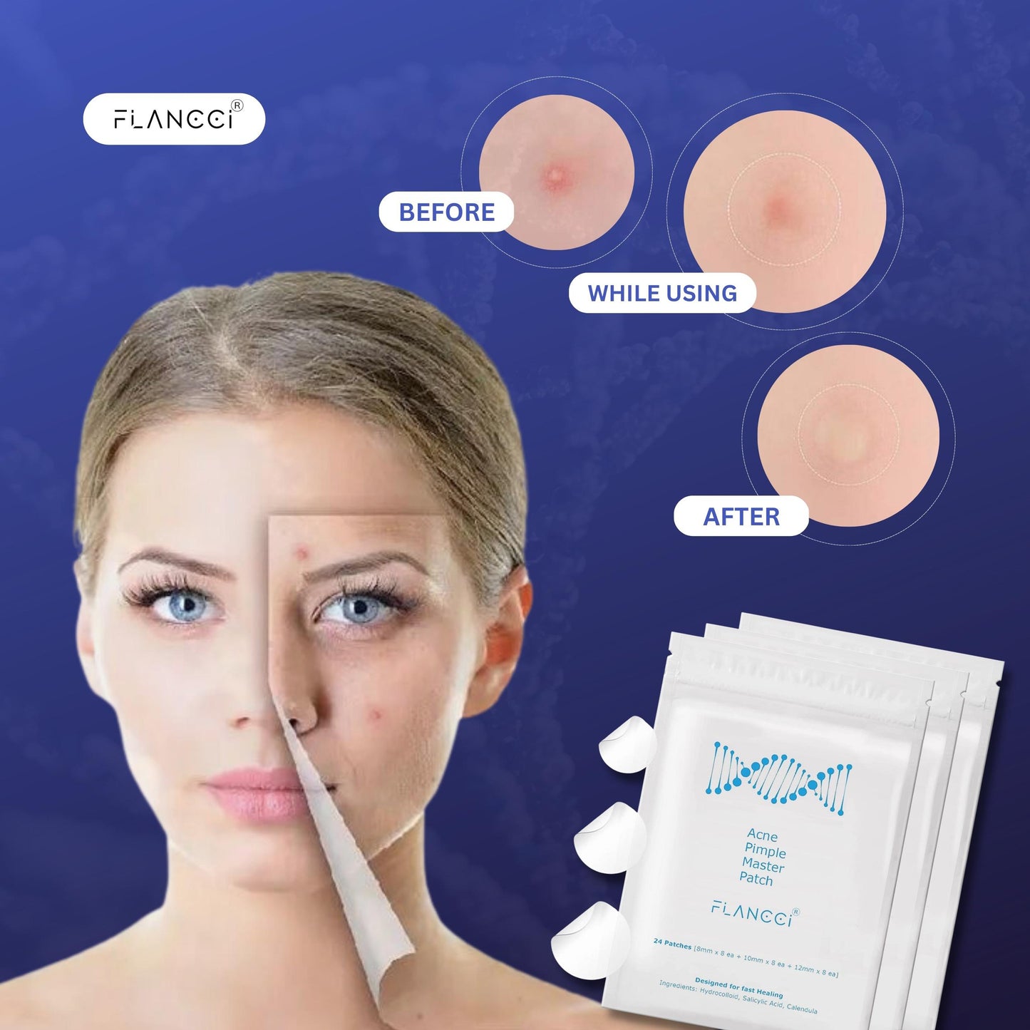 Pimple Patch Acne Patches (24 Count (Pack of 1)) - FLANCCI